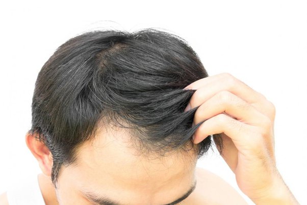 Causes Of White Hair Nutritional Deficiencies