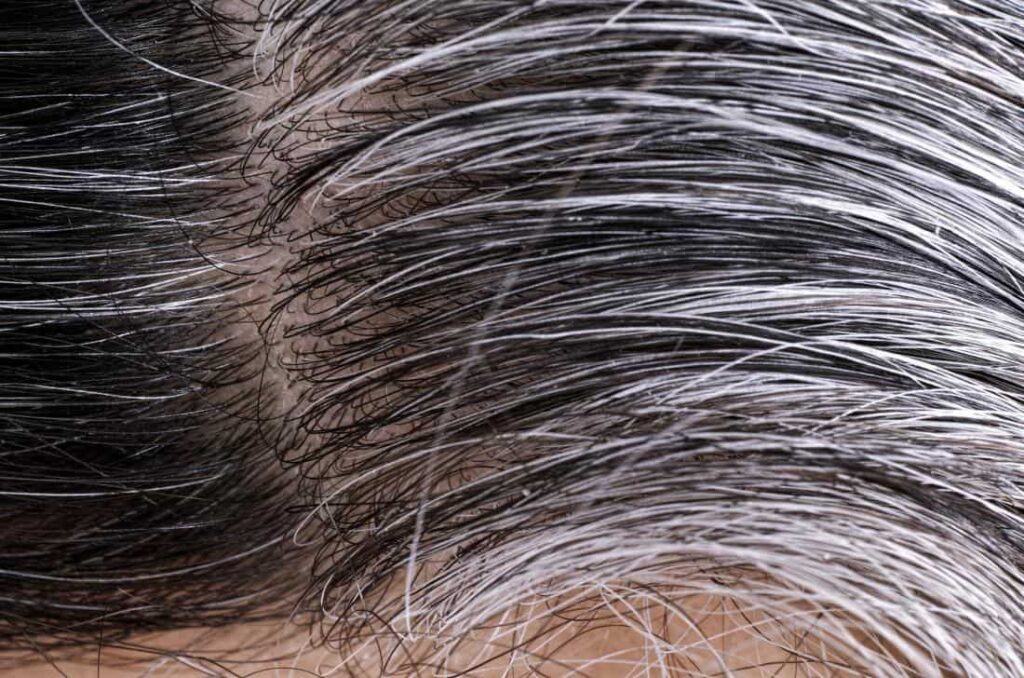 Causes Of White Hair